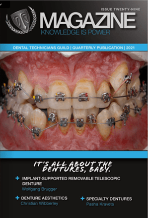 Implant-Supported-Removeable-Telescopic-Denture